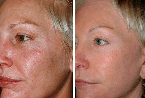 vor und nach der fraktionierten Hautverjüngung Foto 1