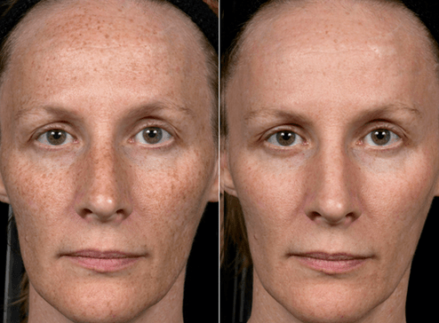 vor und nach der fraktionierten Hautverjüngung Foto 3