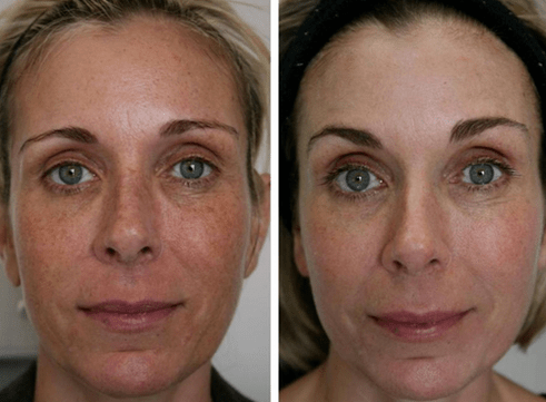 vor und nach der fraktionierten Hautverjüngung Foto 4