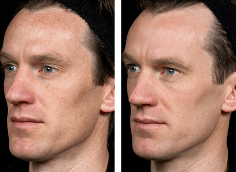 vor und nach der fraktionierten Hautverjüngung Foto 5
