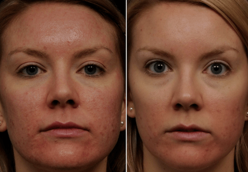 vor und nach der fraktionierten Hautverjüngung Foto 6