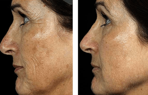 vor und nach der fraktionierten Hautverjüngung Foto 7
