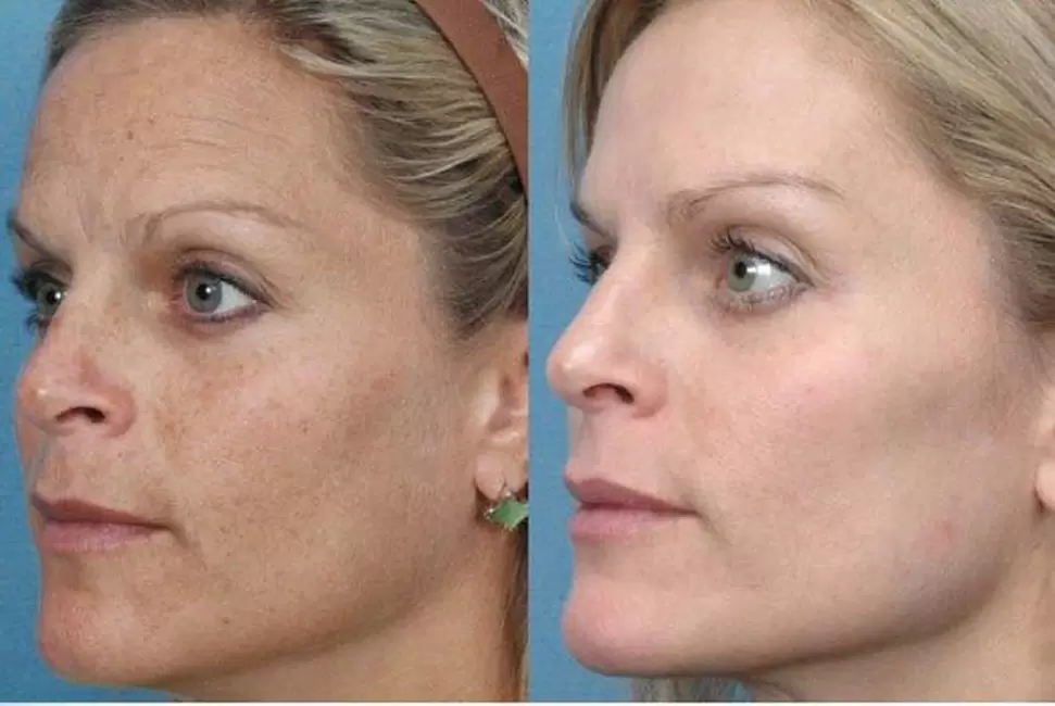 vor und nach Hardware-Hautverjüngung Foto 1