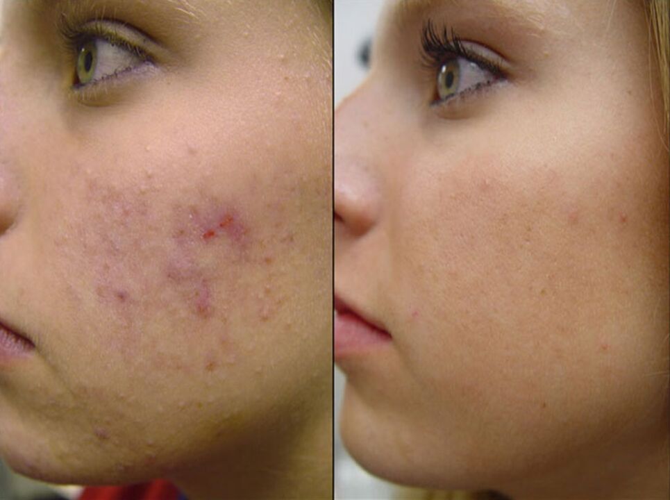 vor und nach Hardware-Hautverjüngung Foto 2