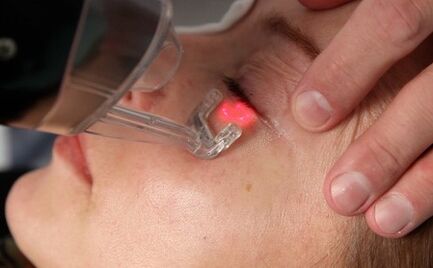 Verfahren zur Laser-Gesichtshautverjüngung